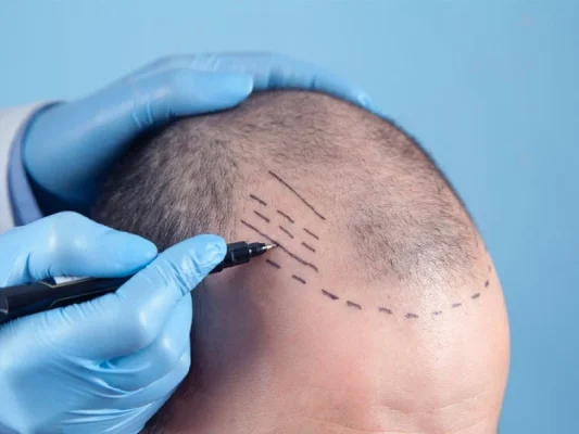 hair transplant